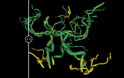 Annotation 3D médicale de scans IRM